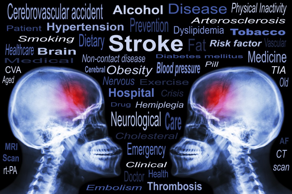 Stroke-1024x682.jpg