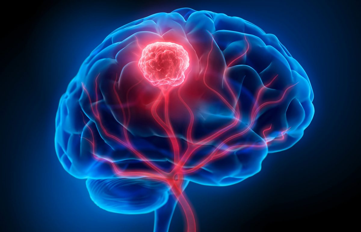Medical illustration of brain tumor
