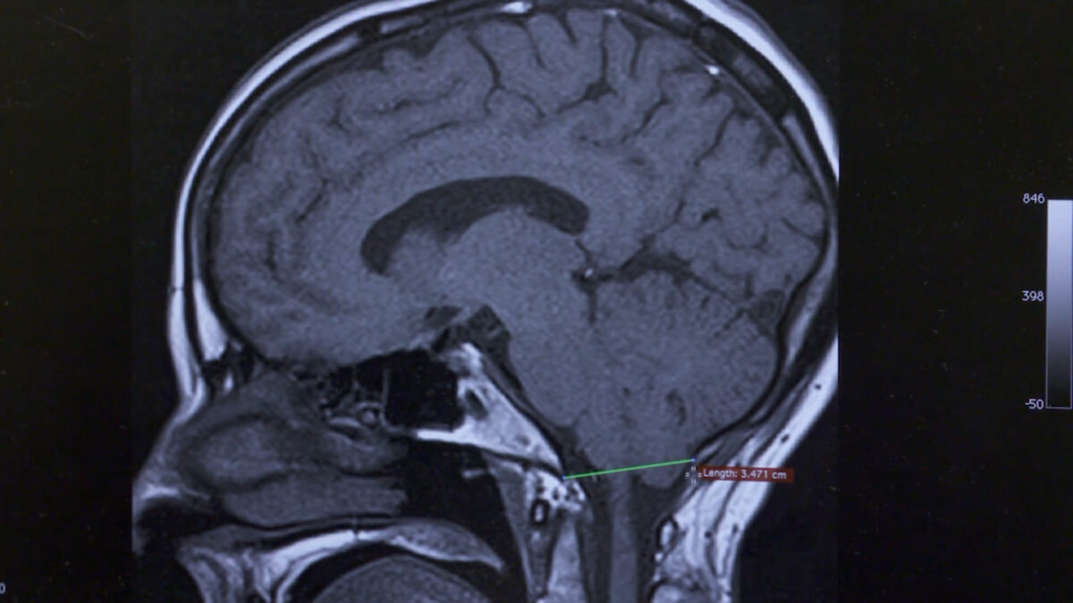 Chiari-Malformation_screenshot_MHSI-1200x675.jpg