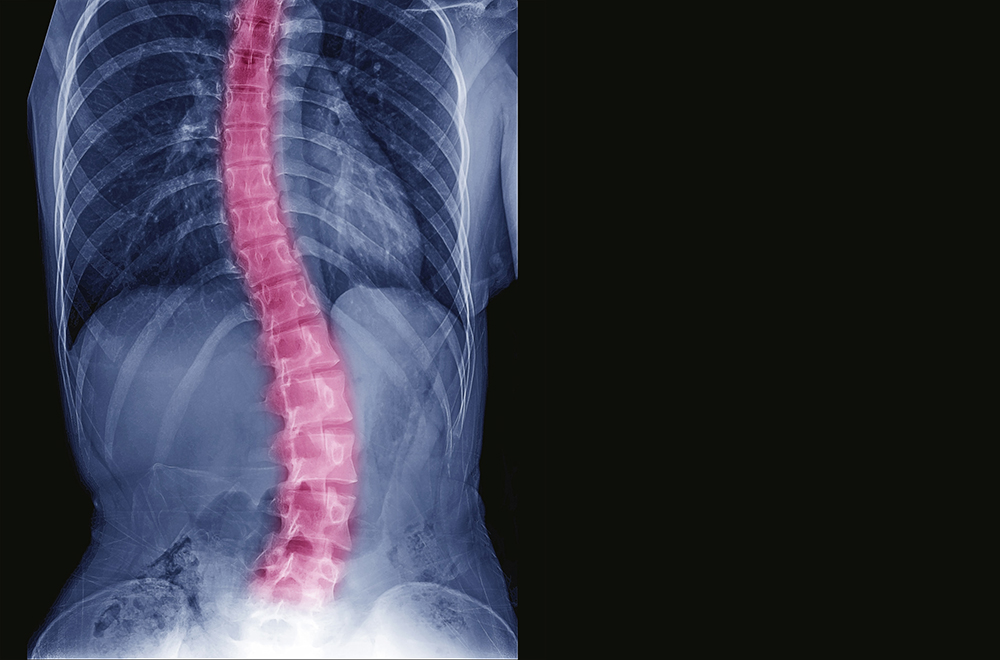 Steele-Xray-Blog_Scoliosis-945206642_MHSI_blog.jpg